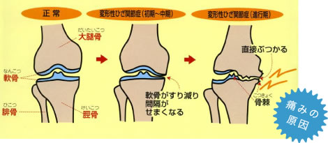 人口膝関節