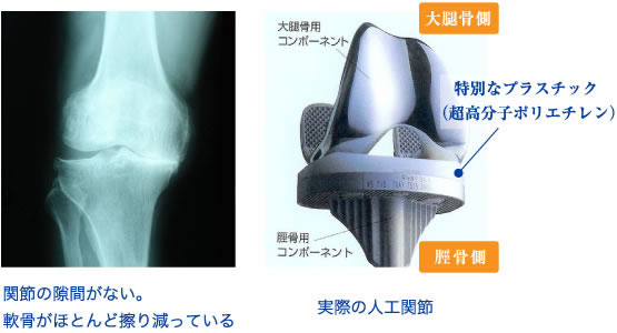 人工関節
