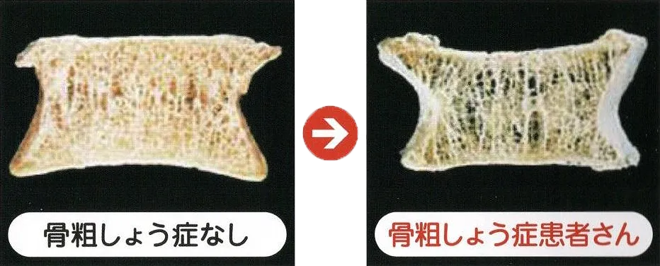 骨粗しょう症