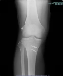 術後のレントゲン写真、脛骨（すね）側には靭帯を止める固定具が入っている。大腿骨（太もも）側にはエンドボタンが入っている。